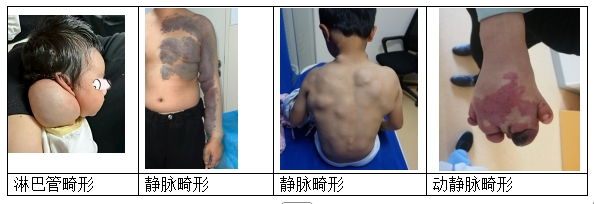 孩子反复疼痛或因脉管畸形，微创介入治疗为健康保驾护航