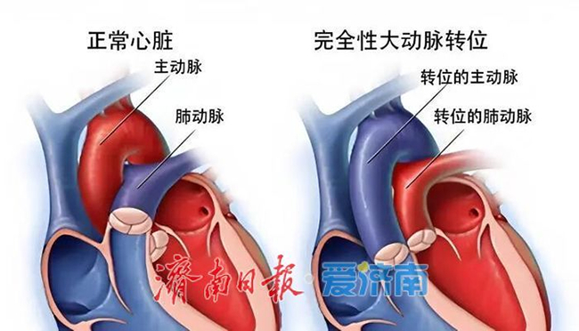宝宝心脏“搭错线”，72小时重获“心”生 山东大学附属儿童医院心脏外科成功救治一例完全性大动脉转位新生儿