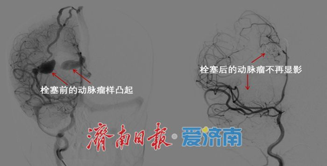 山东大学附属儿童医院神经外科复合手术成功救治5月龄婴儿复杂动脉瘤破裂