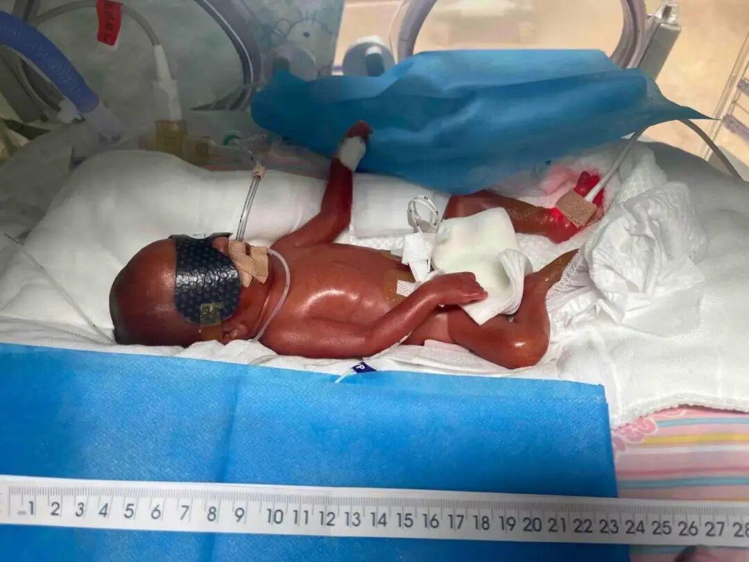 从650g到2.41kg，超早产“掌心宝宝”的96天重生之旅