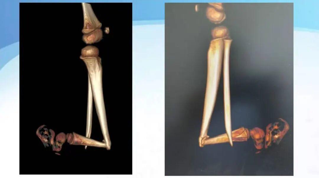 女孩骨折后腿畸形用膝盖走路，山大附属儿医用爱心手术托起童年