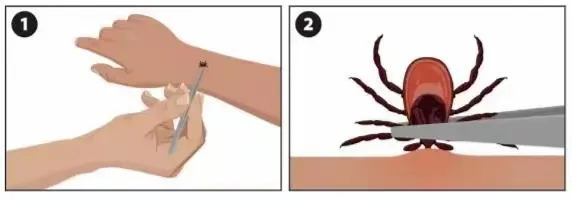 被它叮咬，严重可致命！专家：小心蜱虫，做到正确处理和防护