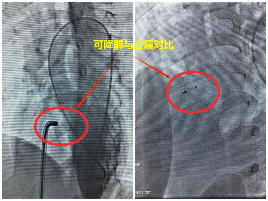 告别“终身留存”，可降解封堵器为儿童室间隔缺损治疗开辟新路径