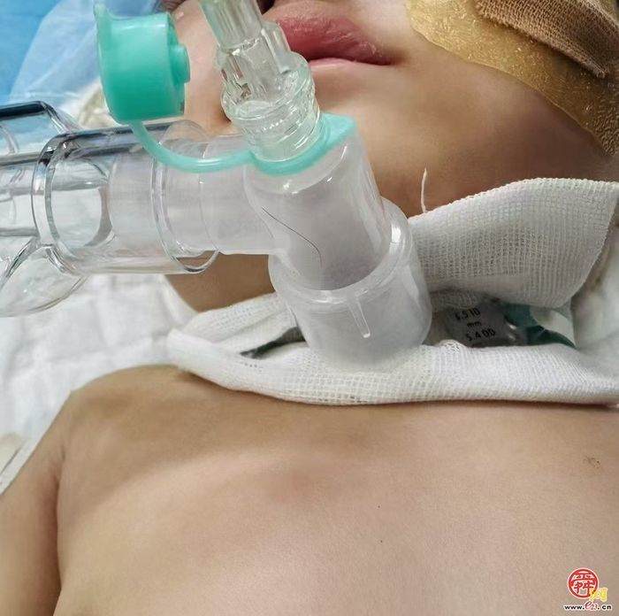 山东大学附属儿童医院多学科联合成功为4kg小婴儿行气管切开术