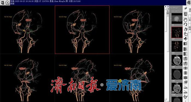 山东大学附属儿童医院神经外科复合手术成功救治5月龄婴儿复杂动脉瘤破裂