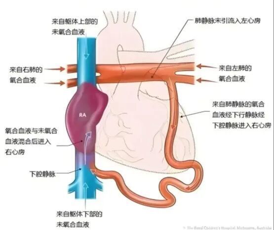 围术期一体化治疗，山大附属儿童医院成功救治一例患有复杂先心病的新生儿