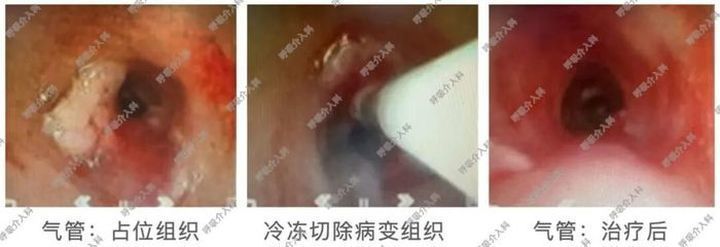 紧急打通“生命通道”，山大附属儿童医院多学科协作成功救治气道梗阻危重症女童