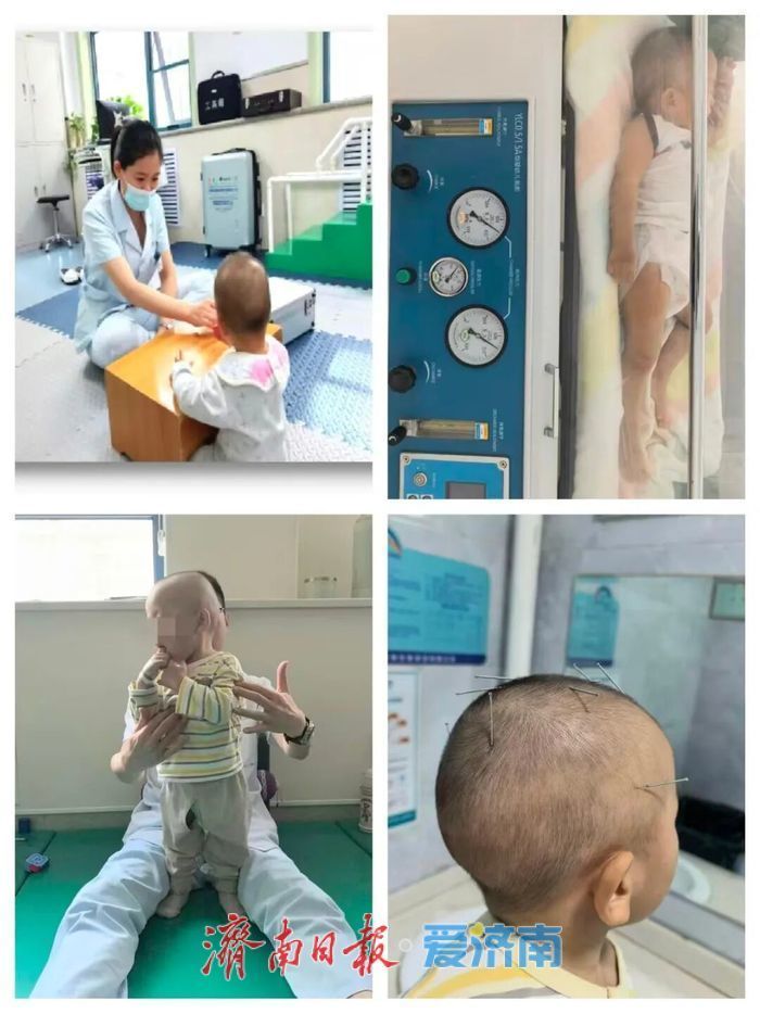13天PICU，2个月康复：济南市儿童医院康复科成功救治1岁9个月窒息患儿