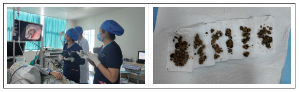 胃石+肠梗阻，不开刀！消化内镜微创精准“排雷”