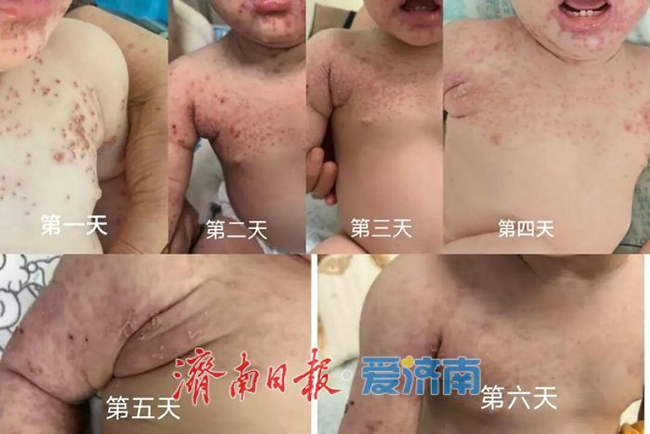 9个月宝宝的“战疹”记：山东大学附属儿童医院感染科守护宝宝 打赢“皮肤保卫战”