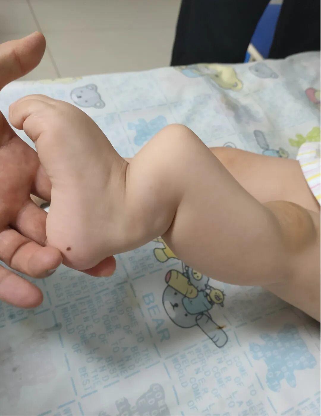 女孩骨折后腿畸形用膝盖走路，山大附属儿医用爱心手术托起童年