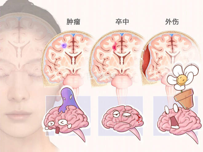 【广州仁爱天河医院】重症康复有多重要？看完别耽误