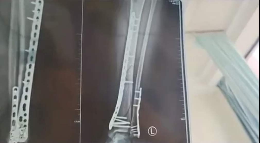 这种拖鞋穿着舒服，其实正在毁掉你的脚