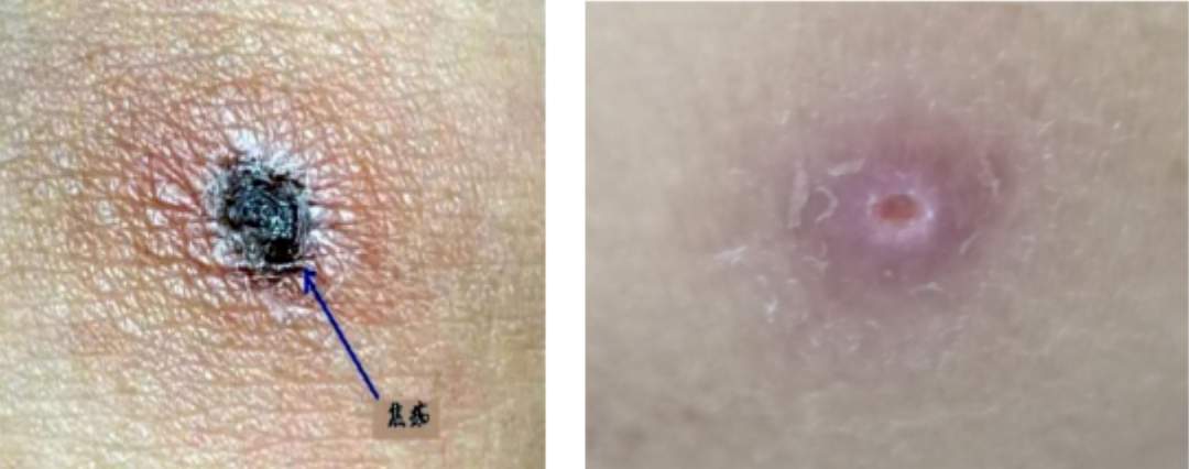 被虫叮一口差点要了命 户外游玩小心这个“小虫子”