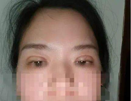 女子做双眼皮手术,结果有12毫米宽!绷不住了:朋友说我像“悲伤蛙”