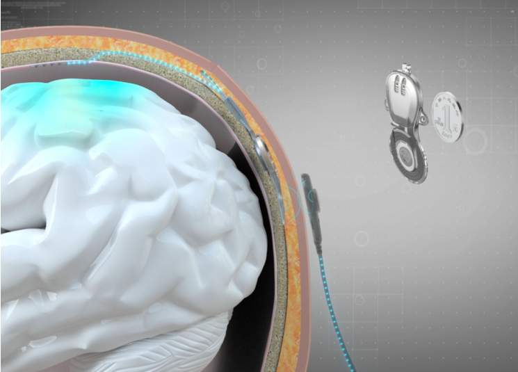 全球首款获批!清华团队让瘫痪患者“想动就动”