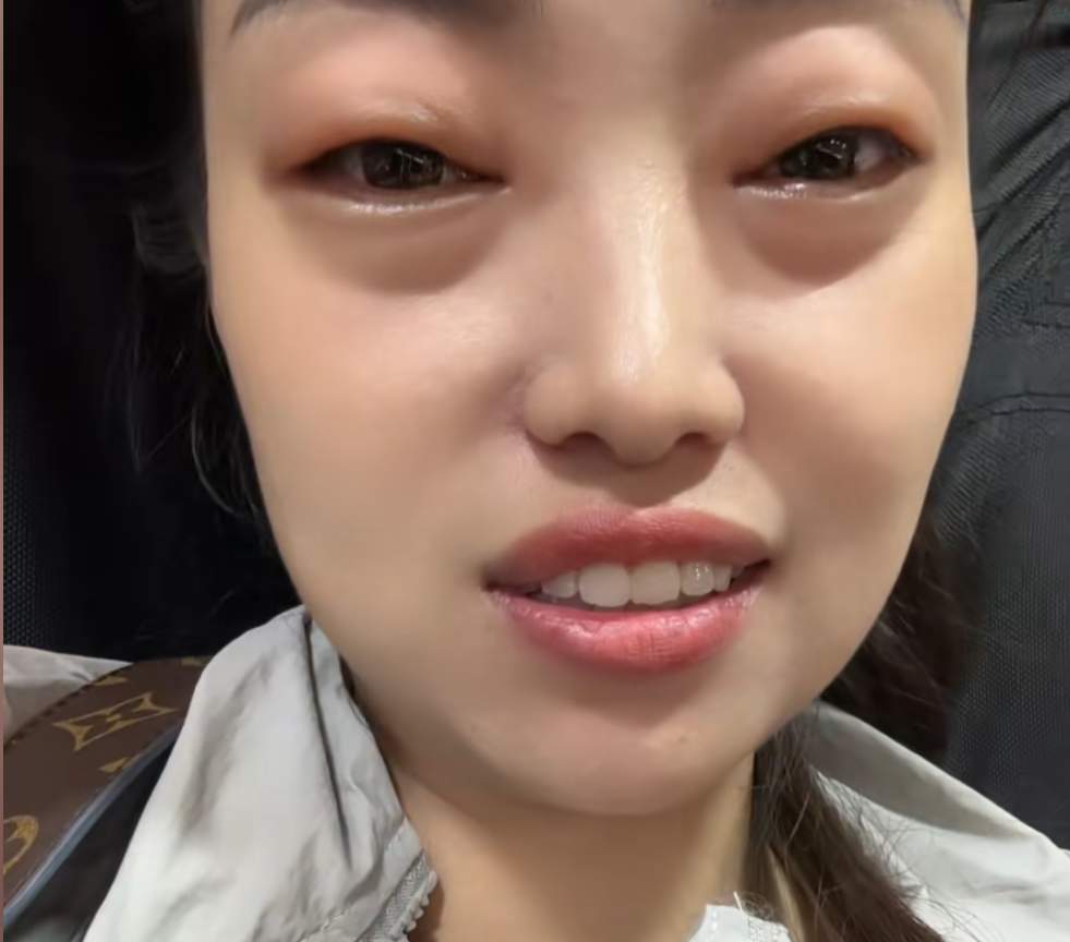 2颗下肚！女子眼睛差点看不见了！正大量上市，有人吃到抢救