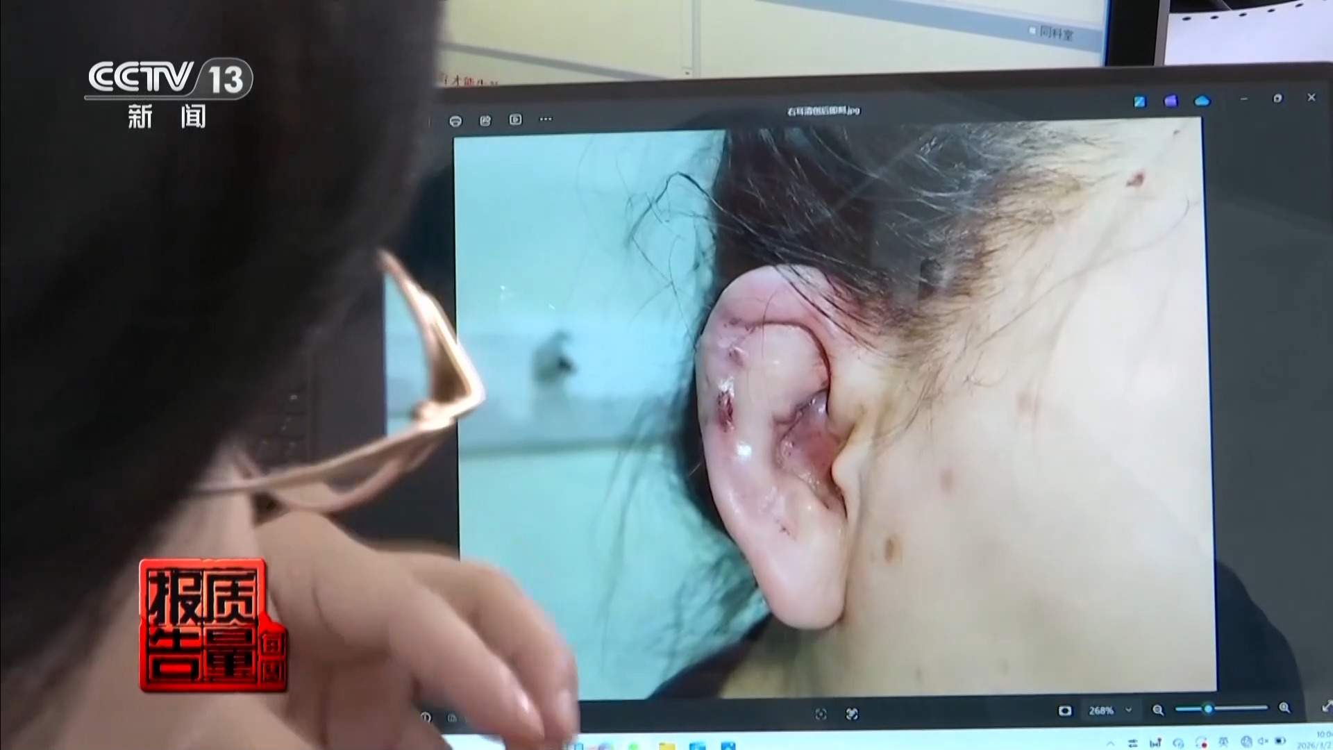 每周质量报告丨“麻药一过，生不如死” 揭秘“精灵耳”整形乱象