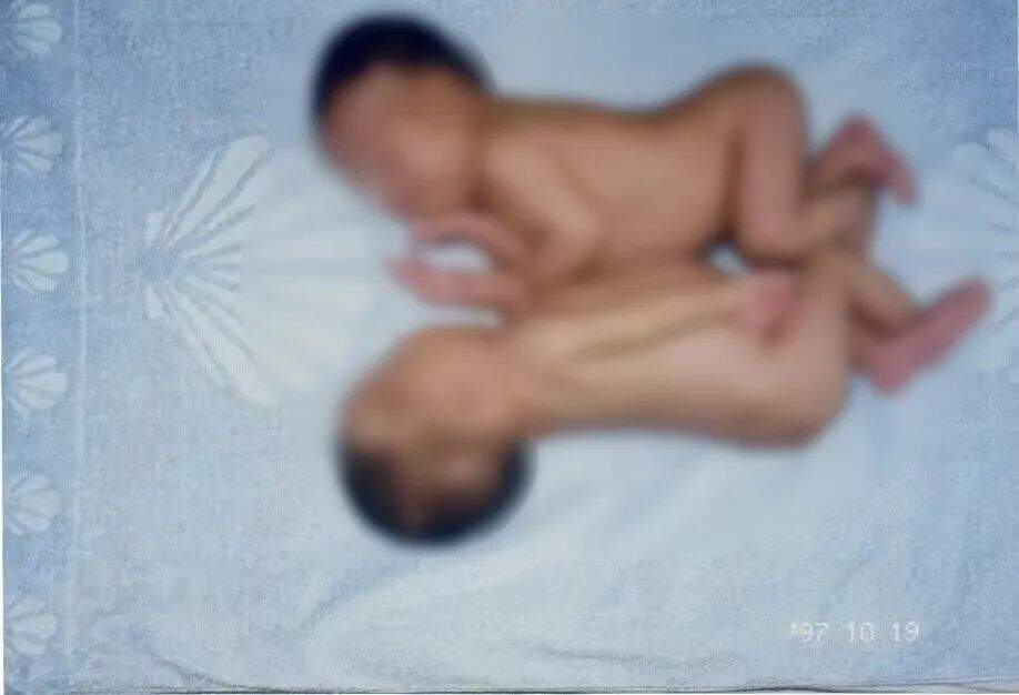 接受连体婴儿分离手术28年后,她当妈妈了!