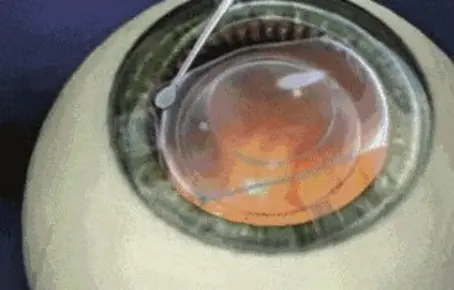 高度近视也能拥有高清夜视力？V5晶体带来清晰新可能