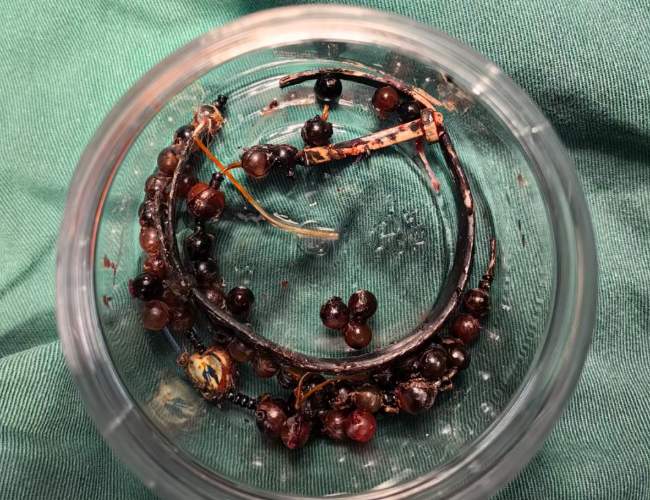 女子手镯10年没摘竟“长”进肉里！医生：再迟就保不住了