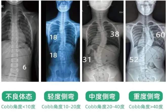 脊柱侧弯复查频率、项目与流程全解析——石家庄直乐医院脊柱侧弯矫正中心复查须知