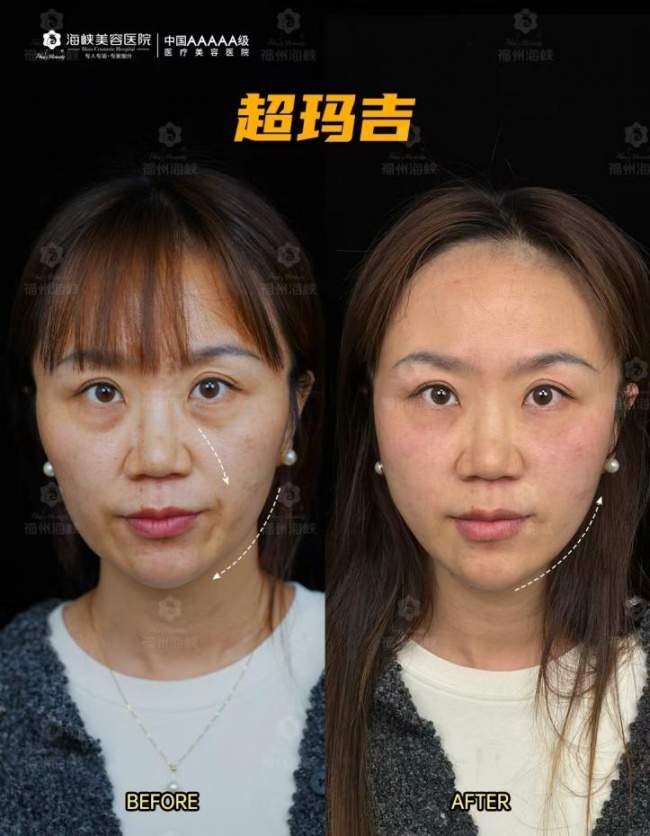 福州联合抗衰如何选？福州海峡林智斌全龄热玛吉联合方案，击破复合衰老难题