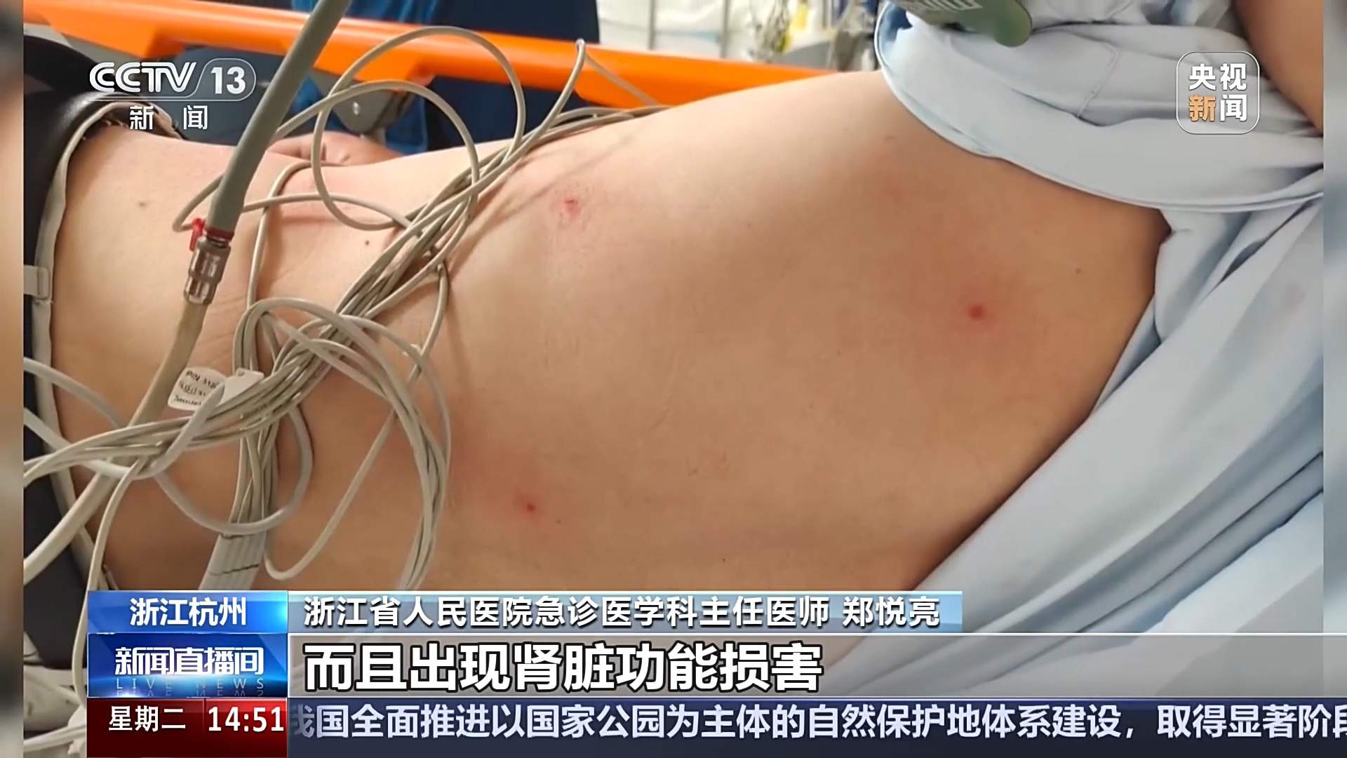 台风前后蜂类攻击性增强！医生提醒：被蜇伤不能热敷