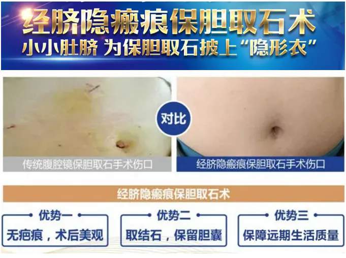 胆结石手术告别“切胆”与“留疤”！经脐隐瘢痕实现无痕保胆【四川结石病医院】