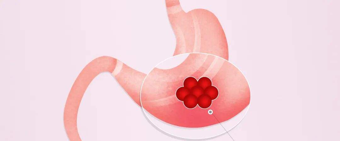 预防胃癌，胃镜筛查很重要！这些人群一定要重视｜肿瘤防治早知道
