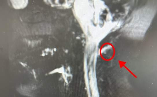 32岁男子脑子“漏水”竟与这个动作有关!