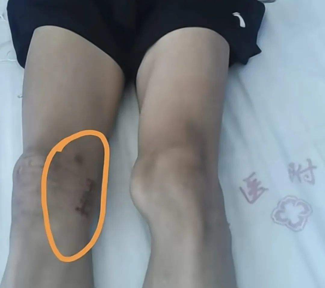17岁男孩腿部手术，居然左右膝搞错！母亲最新发声