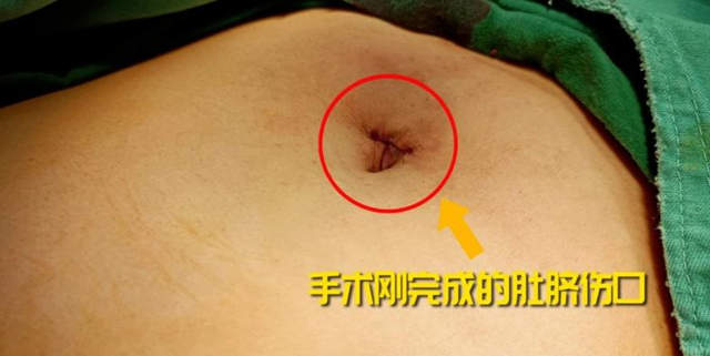 黔南小伙“无痕”心愿成真：贵阳结石病医院医生妙手保胆不留痕