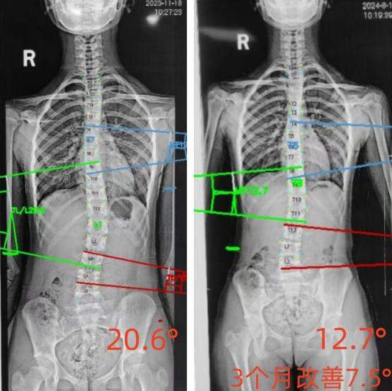 青少年脊柱守护行动——挺起少年脊梁