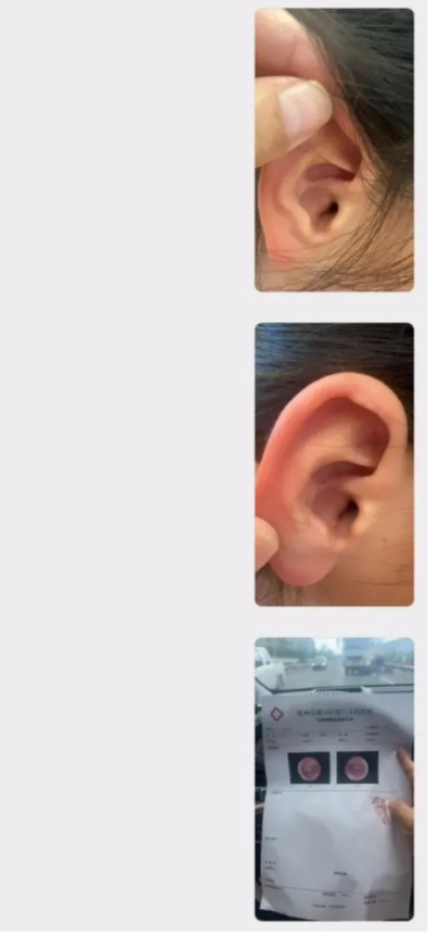 男孩去水上乐园玩水感染传染性软疣 不明的脂肪粒伴有痛痒