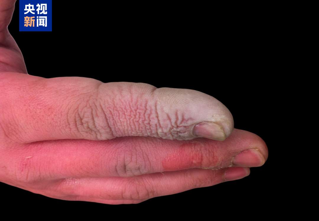 女子误碰“化骨水”身亡,专家:少量接触也可致命