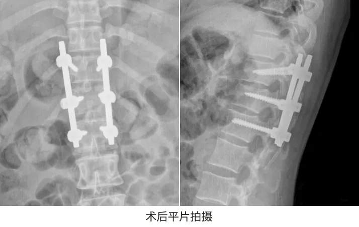 从2米高处坠落，胸椎骨折｜深圳永福医院骨科王林主任团队成功手术，术后第二天她重新站了起来