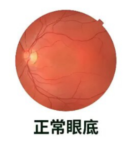 今年的好视力从“眼底一张照”开始！如果您过了50岁，一定要注意啦