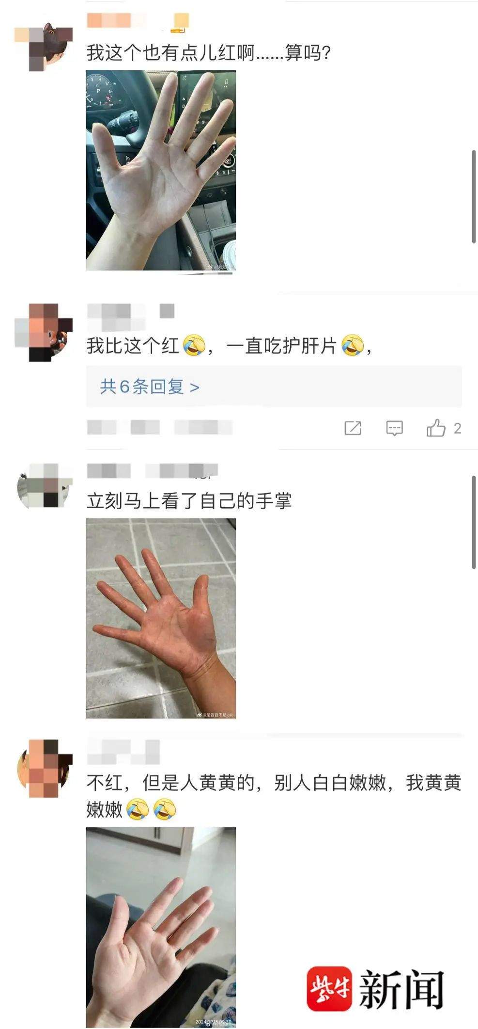 女子网上“晒手掌”，网友提醒赶紧去医院，竟真查出肝硬化！