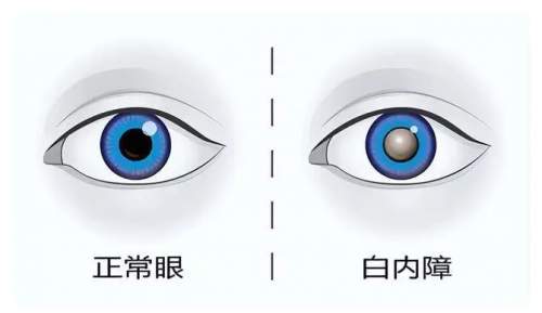 95%的白内障其实不用手术，固本明目颗粒或成调理新方向
