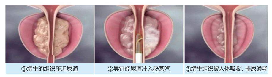 告别四年起夜之苦，八旬老人终于一觉到天明【成都瑞梦诊疗中心案例分享】