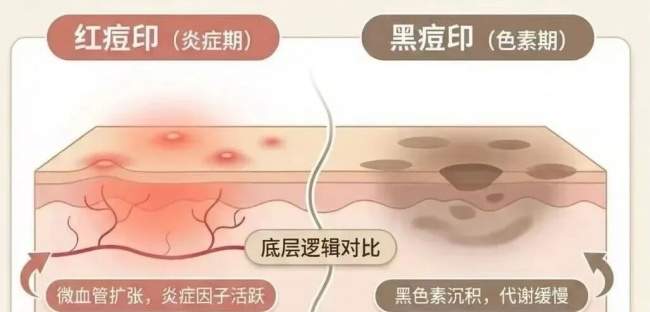祛痘别只消表面炎症！海峡张光泽研创痘全净：分型分阶，先治痘再重建皮肤屏障