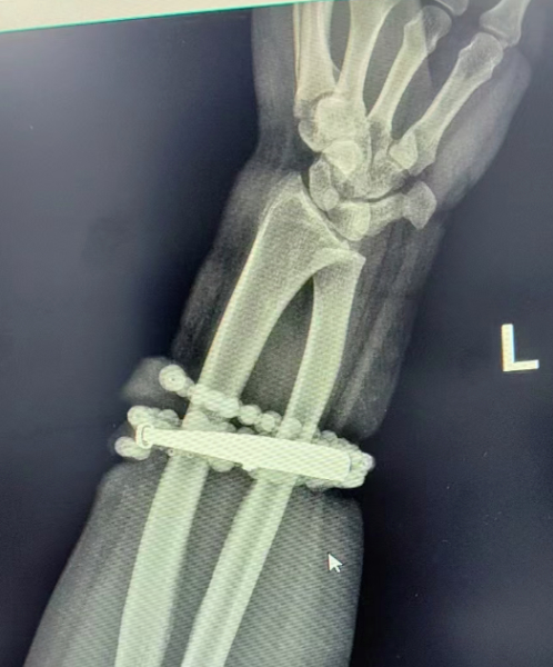 女子手镯10年没摘竟“长”进肉里！医生：再迟就保不住了