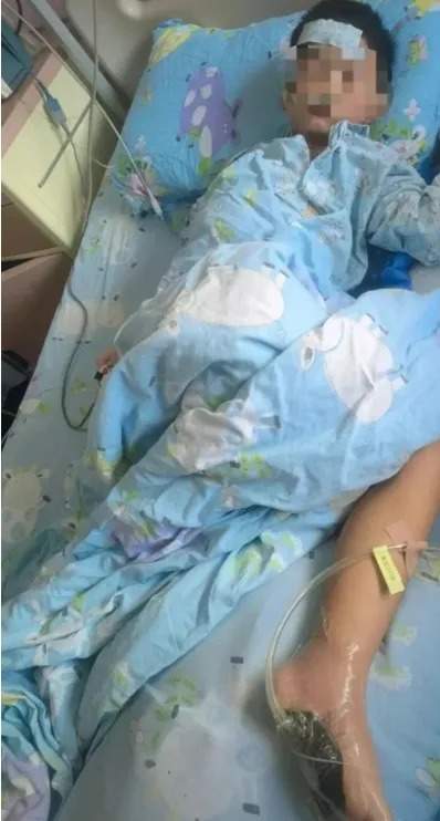 6岁男童沙滩光脚踩到死鱼后高烧进ICU，医生提醒