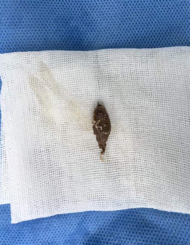 好吃却可能惹出大麻烦 警惕粽子里的“隐形刺客”