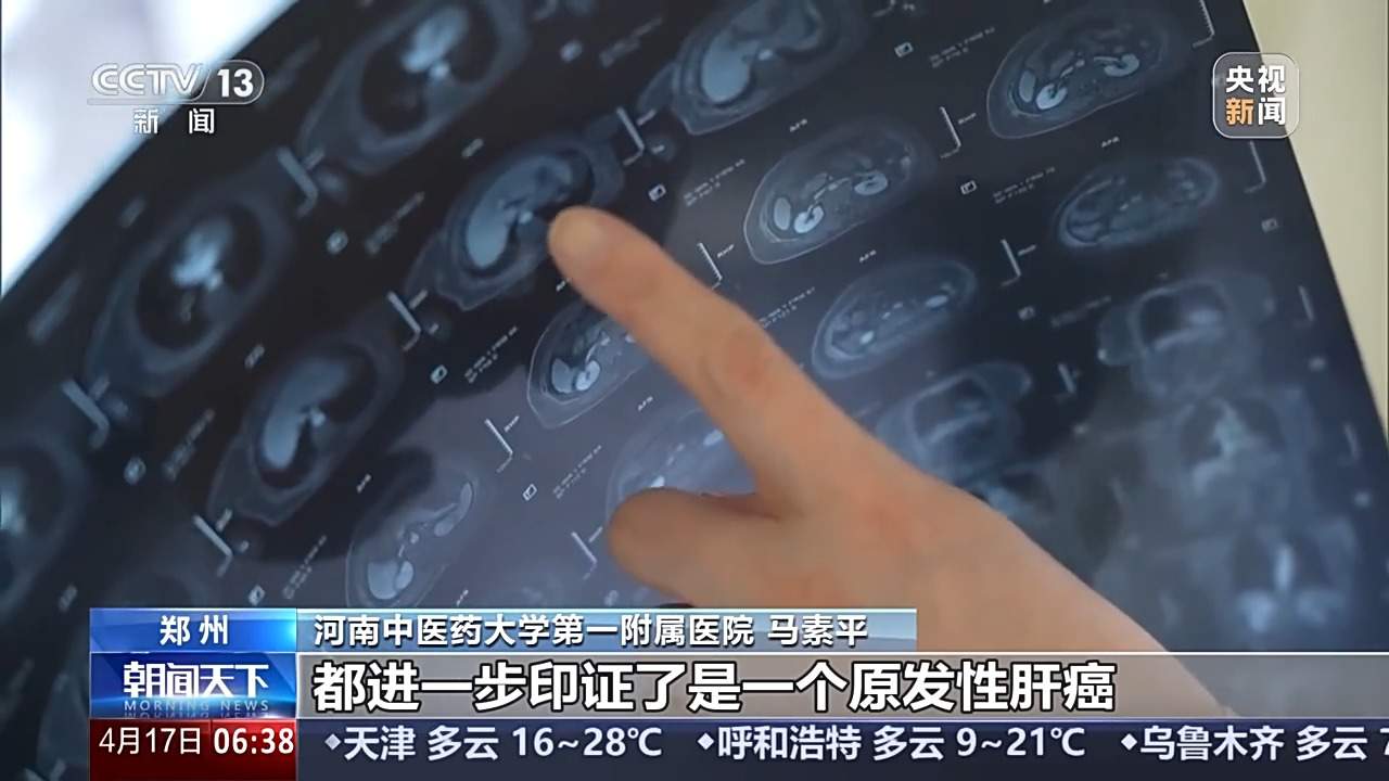 皮肤瘙痒不止一查竟是肝癌!出现这些情况可能是肝在“求救”