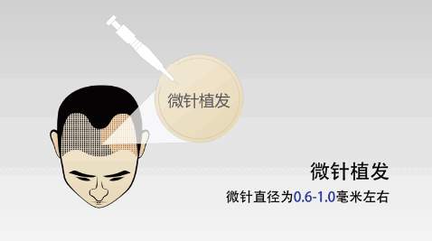 拨开迷雾见真章 到底什么才是正宗的微针植发