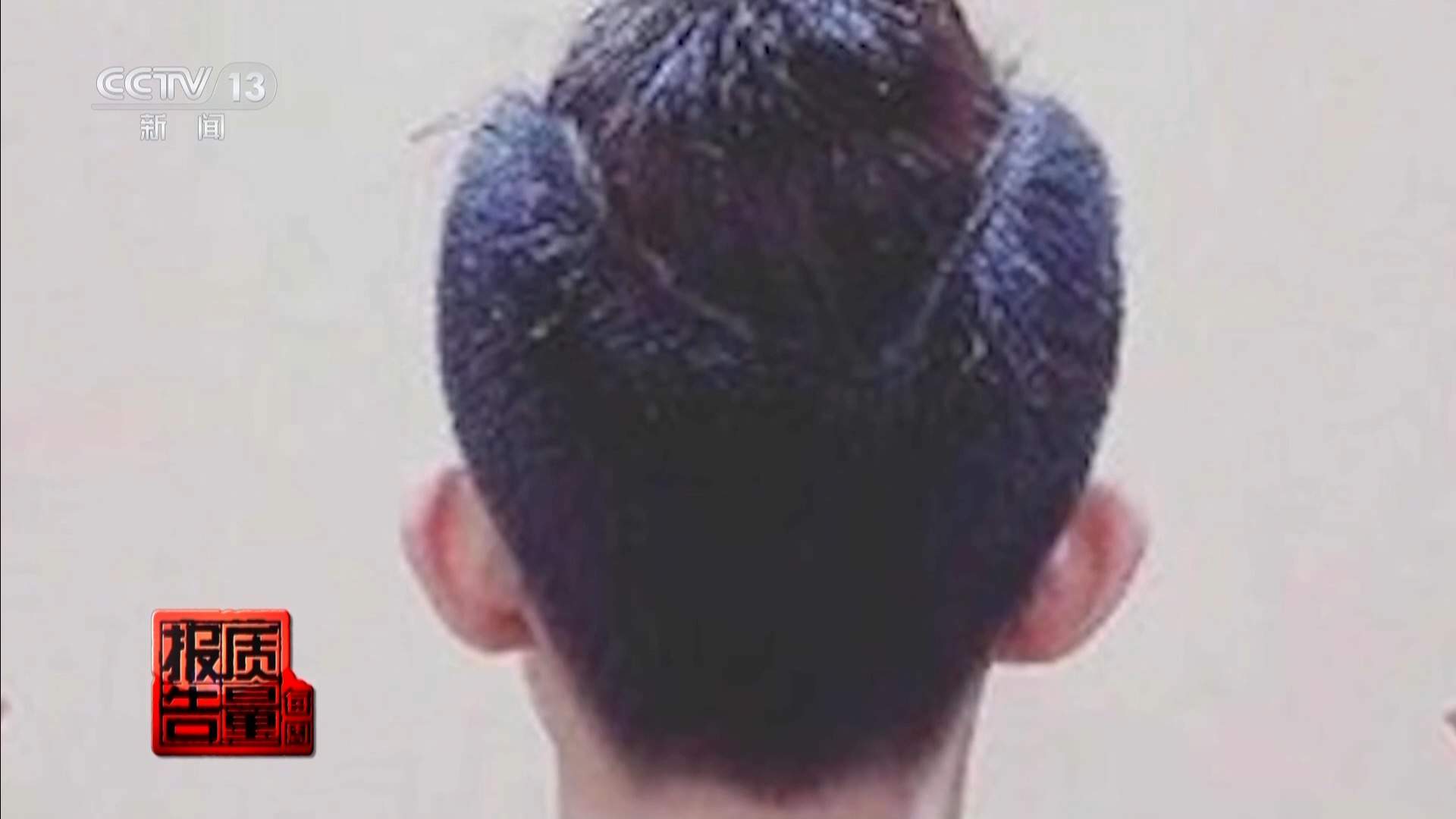 每周质量报告丨“麻药一过，生不如死” 揭秘“精灵耳”整形乱象