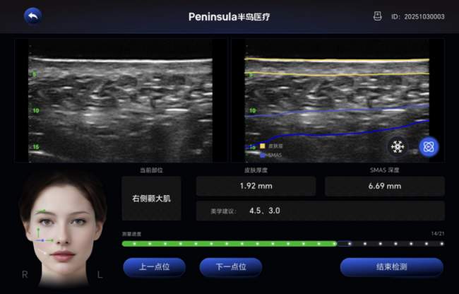 半岛大超炮丨无创精准改善下颌缘松弛