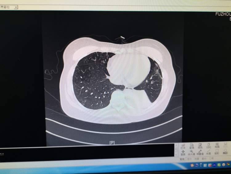 “原来人真的会发霉”,女子中招连咳两个月!